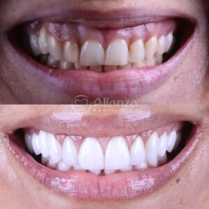 4Casos de paciente odontologia dentes alianza belo horizonte.jpg