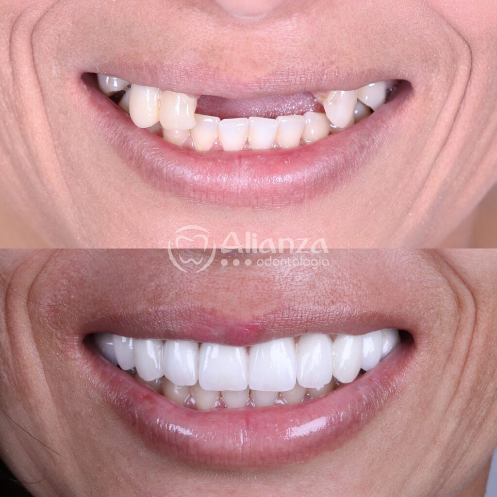 7Casos de paciente odontologia dentes alianza belo horizonte.jpg