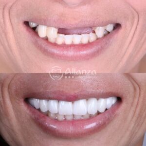 7Casos de paciente odontologia dentes alianza belo horizonte.jpg