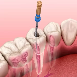 ENDODONTIA-tratamento-de-canal