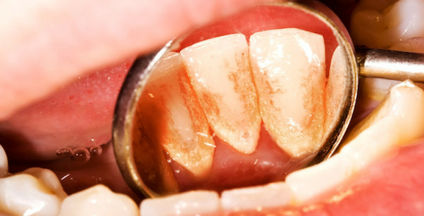 Periodontia Clinica odontologica alianza em belo horizonte