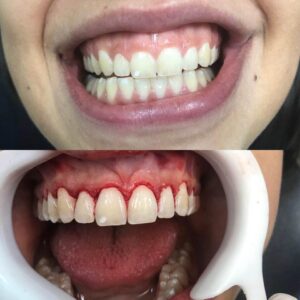 gengivectomia Implantes dentarios em Belo Horizonte Alianza Odontologia